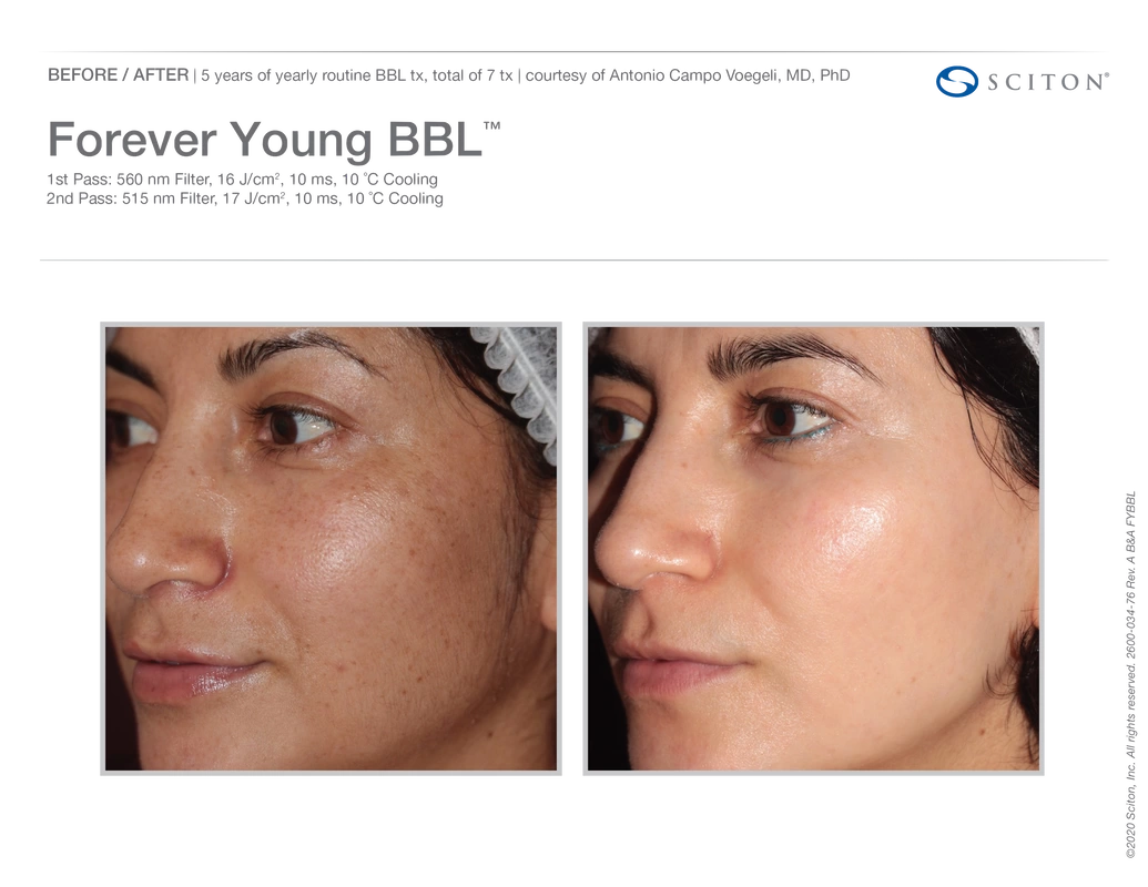 Rapidly Remove Sun Damage ANYWHERE on your Body with BBL HERO™ - Skin  Artisans